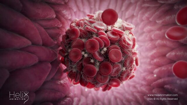 Exclusive: 70% of embalmers report finding strange blood clots beginning in mid-2021